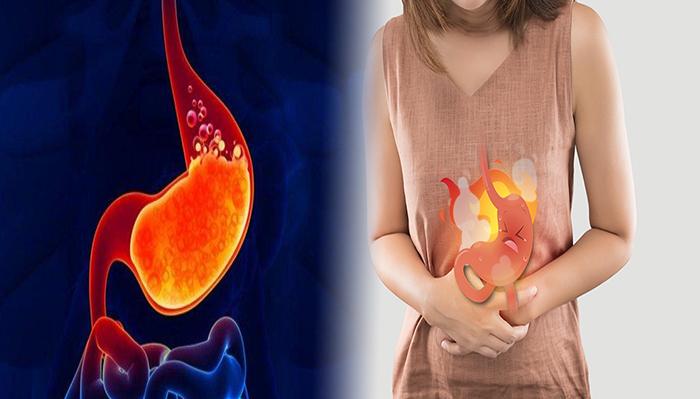 Penyebab-Kambuhnya-GERD-dan-Asam-Lambung-Akut.jpg