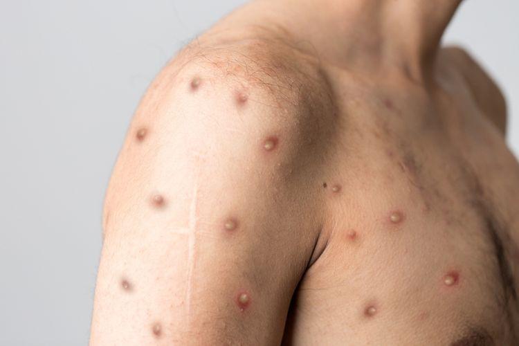 Dinas Kesehatan Sambas Minta Warga Kenali Gejala Cacar Monyet