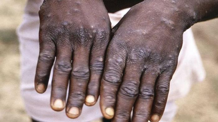 Perbedaan Cacar Air dan Cacar Monyet ! Ketahui Apa itu Virus Cacar Monyet atau monkeypox