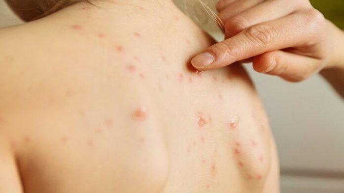 Kadiskes Kalbar Tindaklanjuti Imbauan Kemenkes Terkait Tata Cara dan Pedoman Penanganan Monkeypox