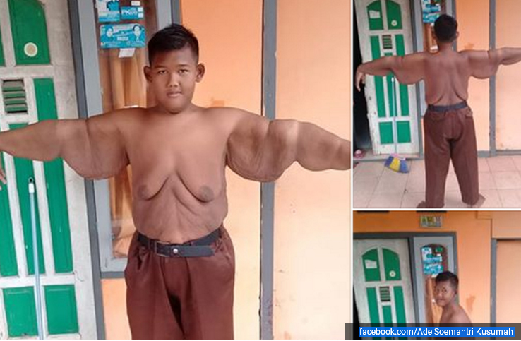 Bocah Ini Kehilangan 100 Kilogram Berat Badannya Berkat Operasi Bariatrik, Begini Hasilnya