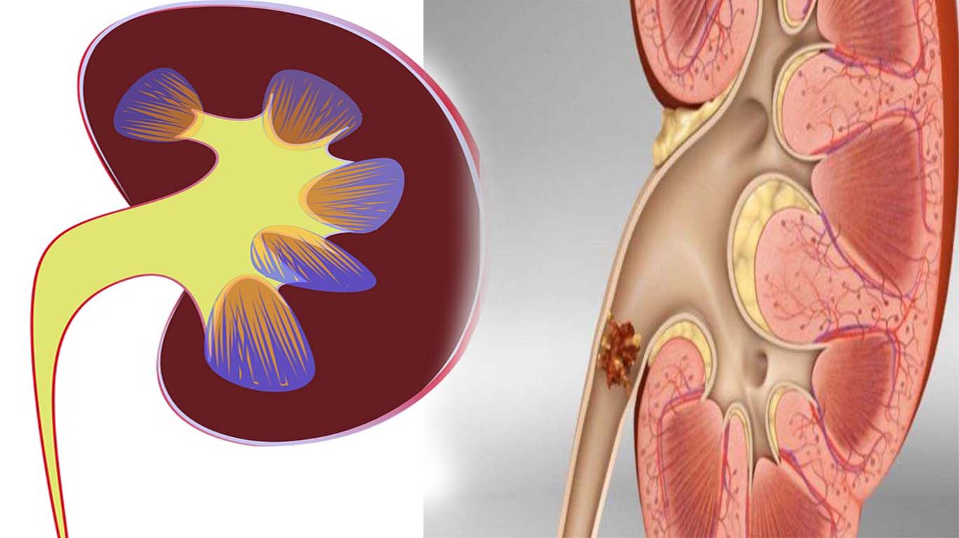 batu-ginjal-yang-berbagaya-bagi-kesehatan.jpg
