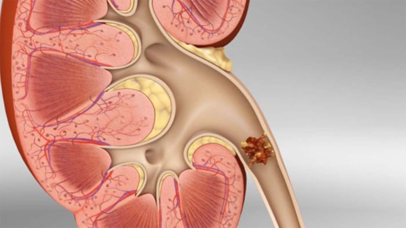 bentuk-batu-ginjal-di-saluran-ureter.jpg