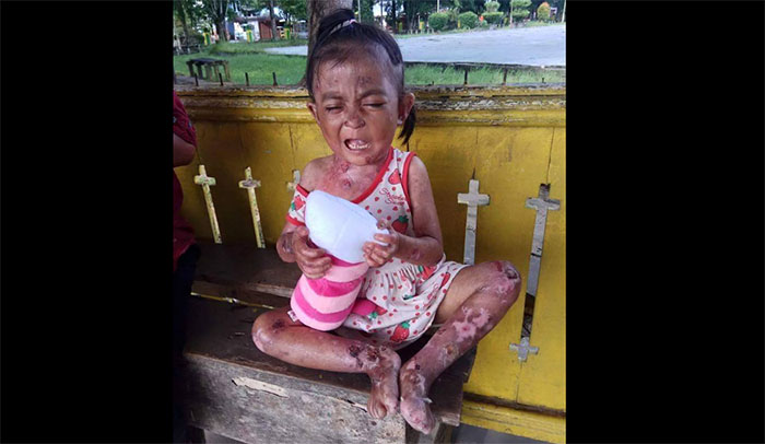 Club Motor Biak Sambas Galang Dana Untuk Nevawati dan Reva - bocah-sakit-kulit_20171024_153021.jpg