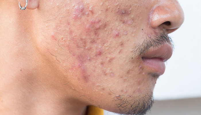 jangan-anggap-sepele-jerawat-timbulnya-di-bagian-tubuh-ini-tandakan-gangguan-jantung.jpg