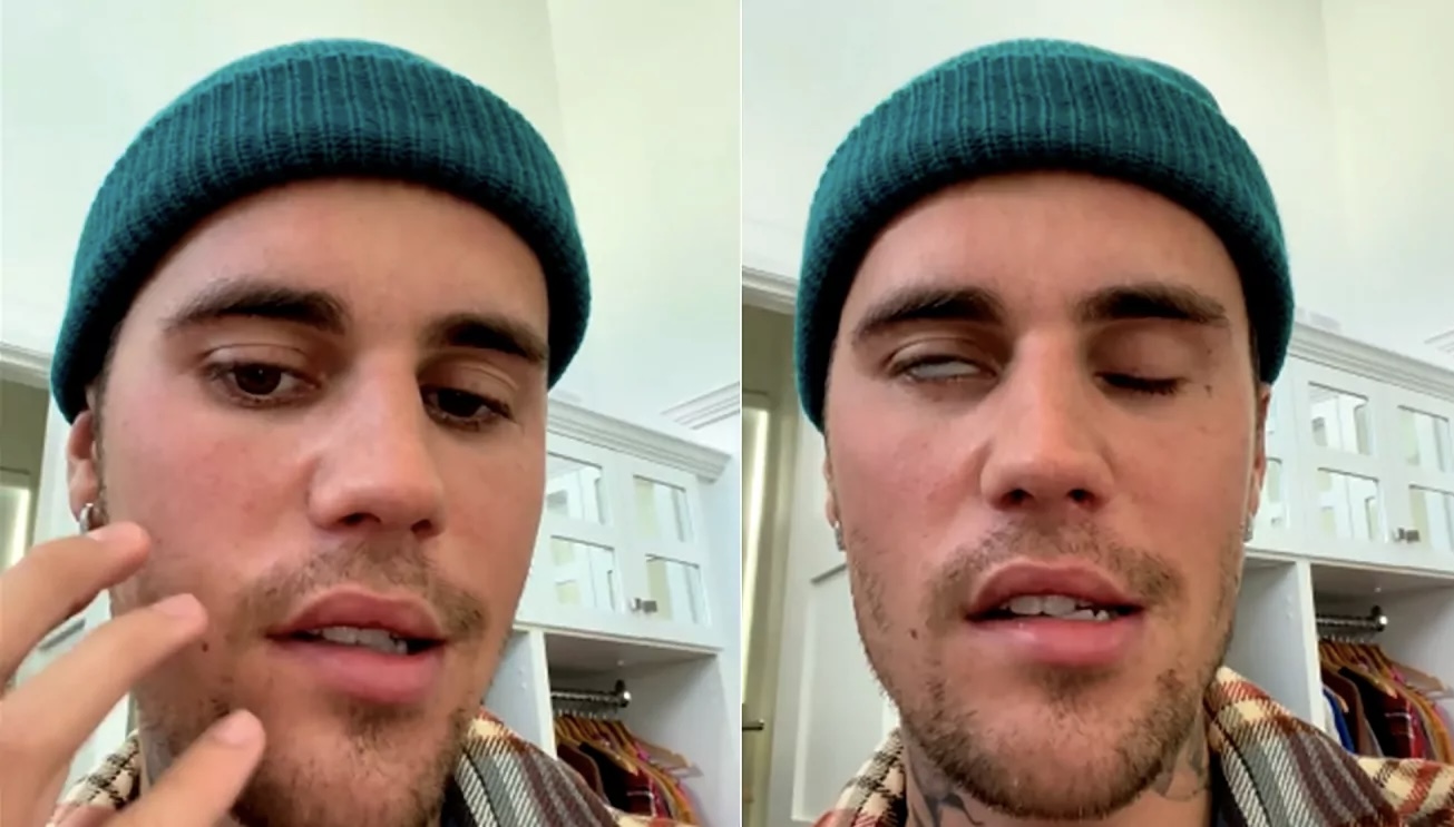 Justin Bieber Didiagnosa Sindrom Ramsay Hunt, Ketahui Sindrom Ramsay Hunt dan Gejalanya