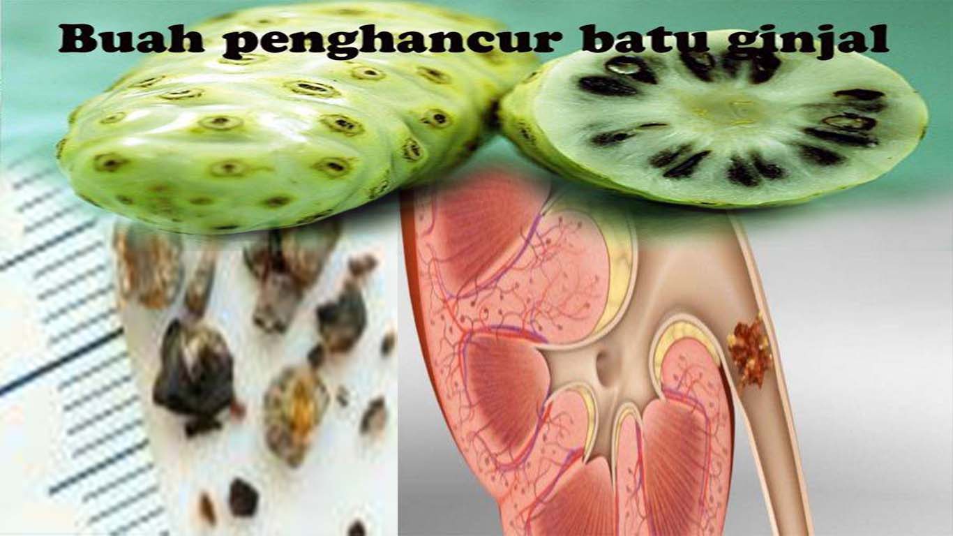 obat-alami-untuk-batu-ginjal.jpg
