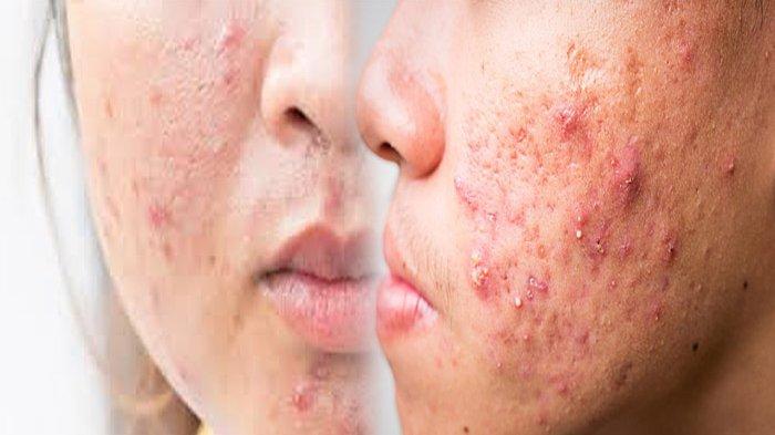 Obati Jerawat dengan Bubuk Cengkeh, Cara Ampuh Hilangkan Jerawat Tak Sampai Sehari