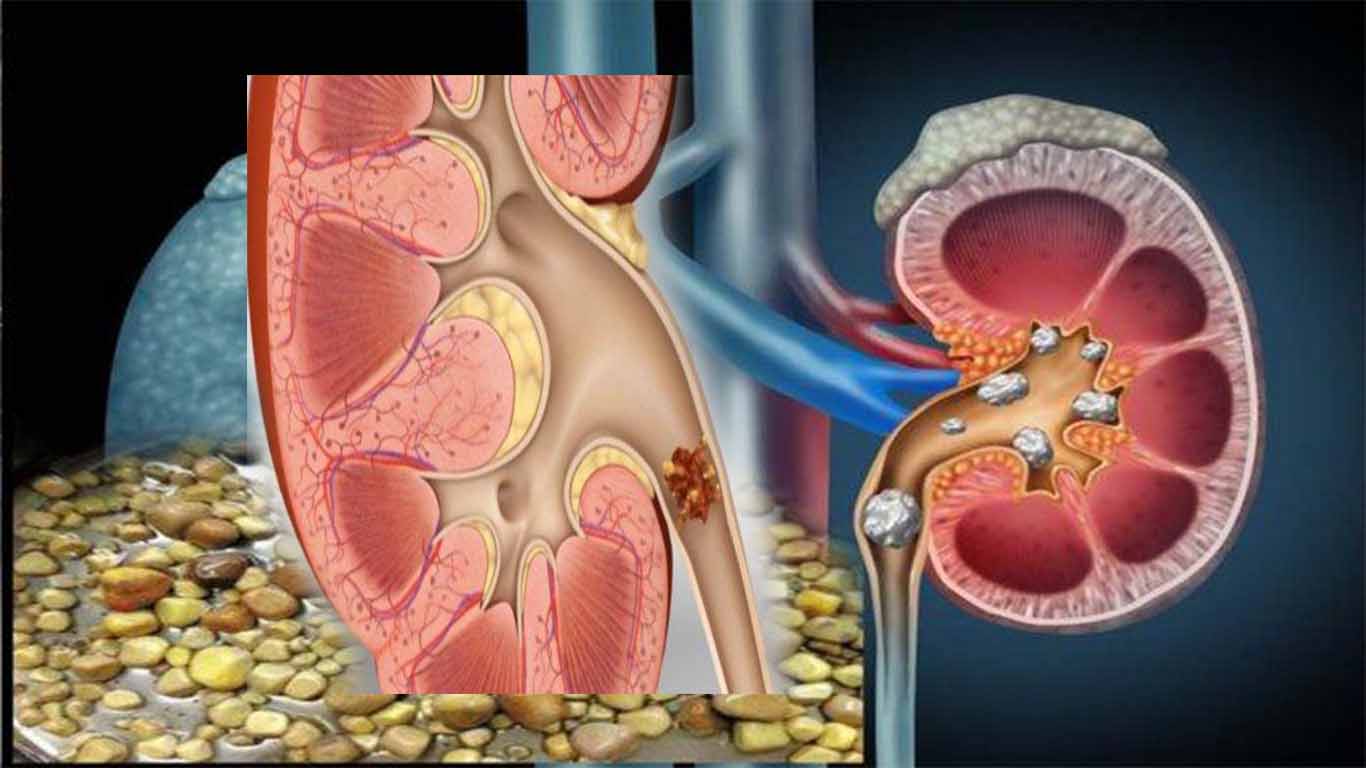penyakit-batu-ginjal-dan-endapan-batunya.jpg