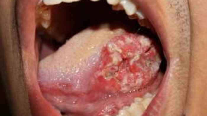 Makanan Enak Ini Sering Dikonsumsi Banyak Orang, Faktanya Bisa Sebabkan Kanker Lidah Hingga Kematian