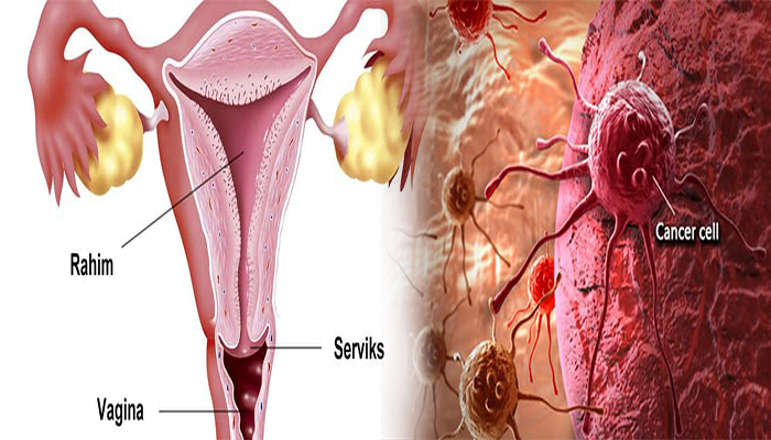 virus-penyebab-kanker-serviks-dan-6-penyebab-kanker-serviks-apa-ciri-ciri-kanker-serviks.jpg
