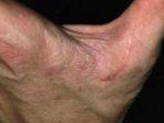 Kulit-yang-terkena-penyakit-Scabies.jpg