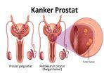 Merokok-dan-konsumsi-alkohol-diketahui-dapat-memicu-kanker-prostat.jpg