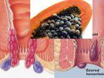 ambeien-dan-cara-mengobatinya-menggunakan-obat-alami-biji-pepaya.jpg