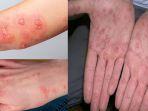 apa-itu-penyakit-scabies-pada-manusia-kenali-gejala-penyakit-scabies-dan-penyebabnya.jpg