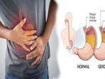 buah-yang-bagus-untuk-asam-lambung-solusi-meredakan-asam-lambung-tanpa-minum-obat.jpg