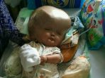 hydrocephalus_20171012_182219.jpg