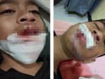 terkena-botol-pewangi_20180625_185458.jpg