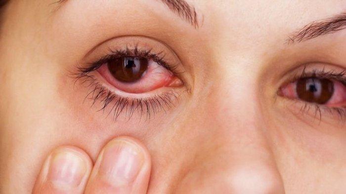 4 Tips Mengatasi Mata Merah Karena Kemasukan Debu, Jangan Digosok Pakai Tangan