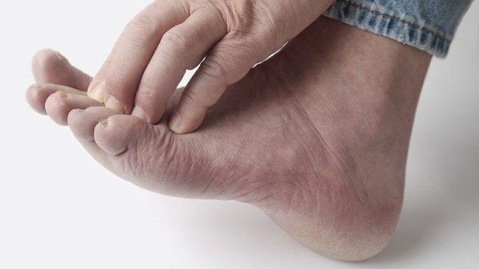 5 Cara Mengatasi Kutu Air Menggunakan Bahan Alami, Praktis dan Minim Efek Samping
