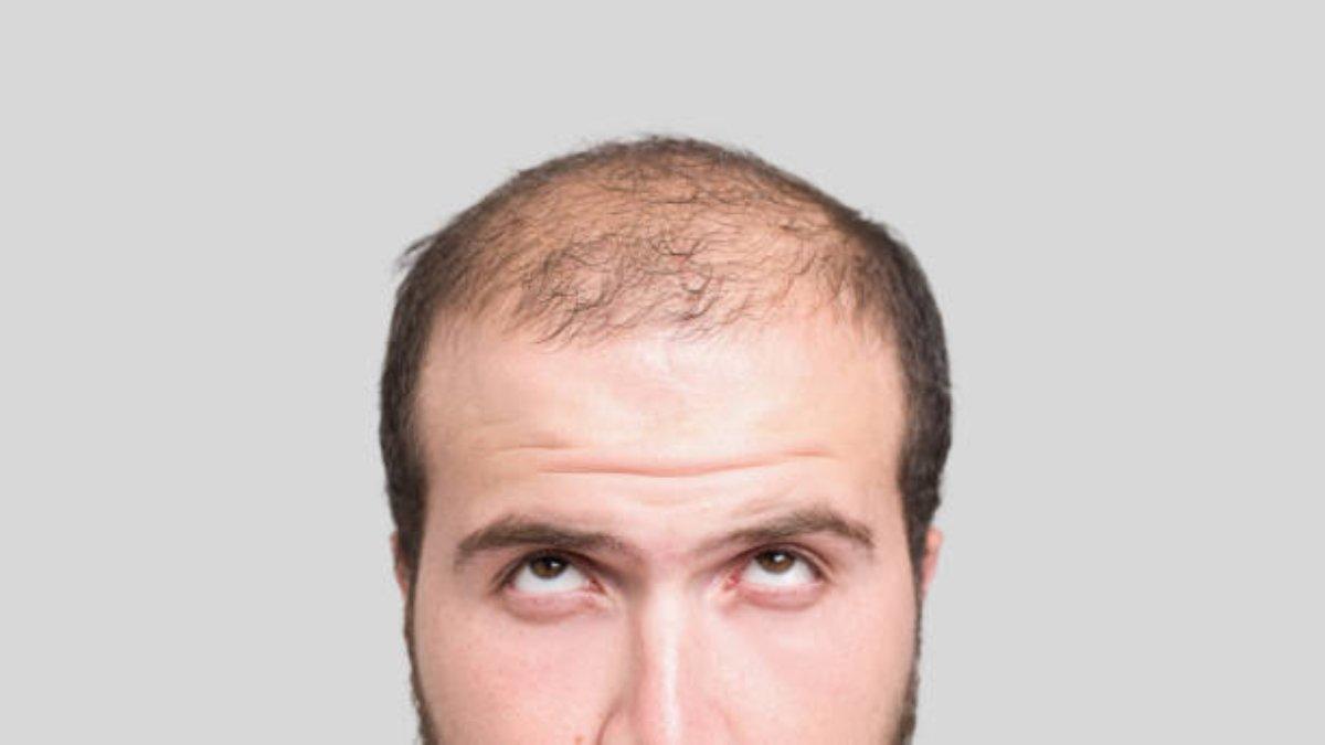 Ilustrasi pria yang memiliki rambut tipis, untuk mencegahnya perlu penggunaan hair serum agar mencegah kebotakan.