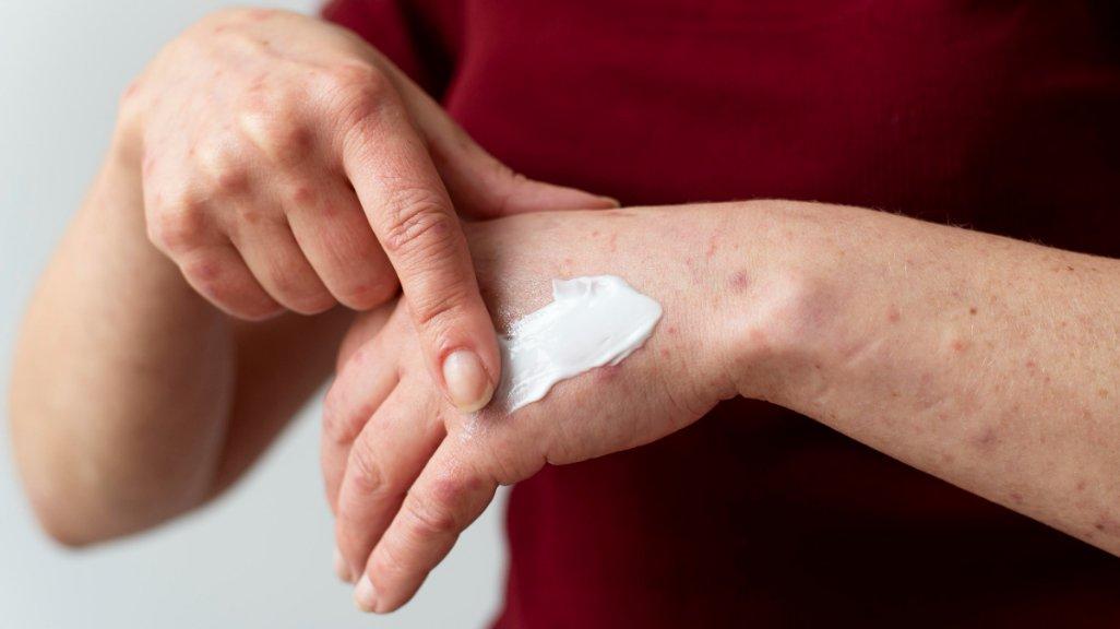 Ilustrasi memberikan obat oles ke kulit sebagai cara meredakan alergi detergen