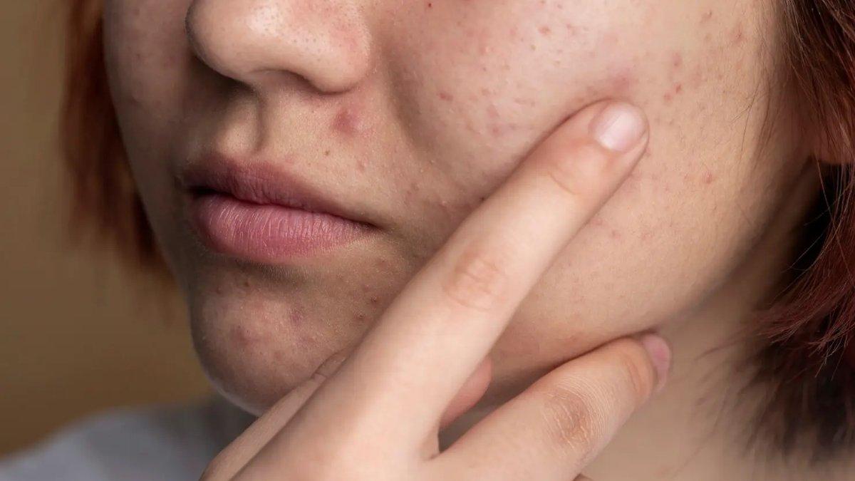 Ilustrasi pori-pori wajah tersumbat akibat melewatkan double cleansing