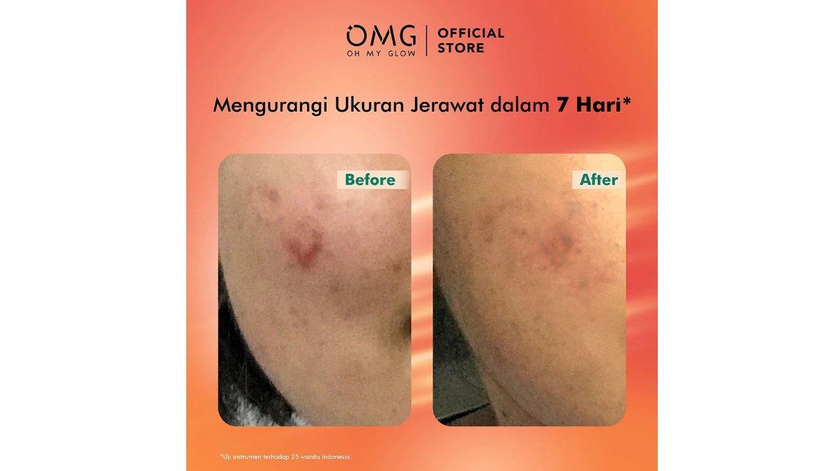 OMG OH MY GLOW Mugwort Acne Serum