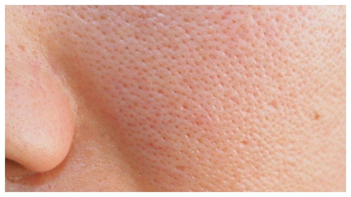 Pori-pori besar bisa disamarkan dengan perawatan menggunakan skincare yang tepat