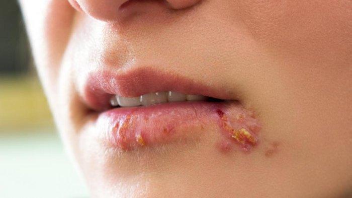 Herpes di Wajah Membuatmu Kurang Percaya Diri? Obati dengan 5 Cara Alami Ini