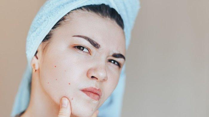 5 Toner Terbaik untuk Atasi Fungal Acne