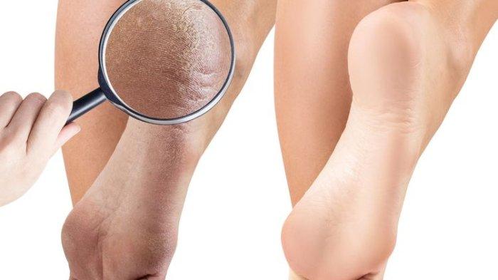 6 Bahan Alami Terbaik yang Ampuh Mengatasi Tumit Kaki Pecah-Pecah, Murah dan Mudah Didapat