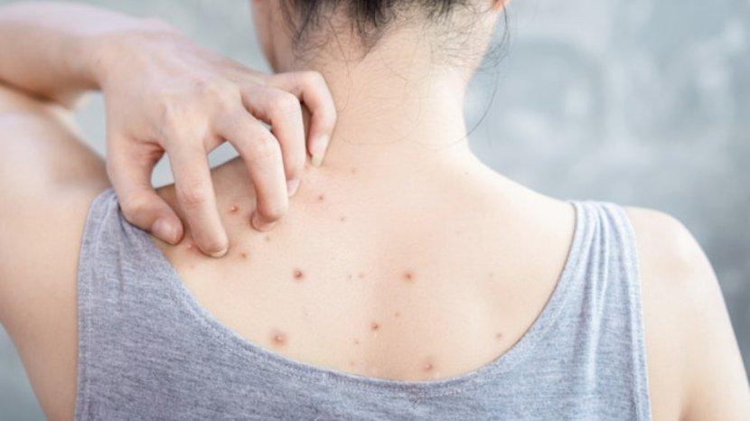 25-Daftar-Sabun-Mandi-Khusus-Jerawat-Punggung-atau-Acne-Back-Terjamin-BPOM-Aman-DIpakai-Setiap-Hari.jpg