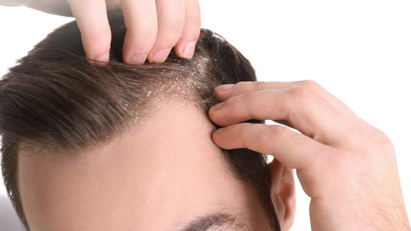 30-Daftar-Shampoo-Terbaik-Penghilang-Ketombe-Hingga-ke-Akar-Tidak-Bikin-Rambut-Kering.jpg