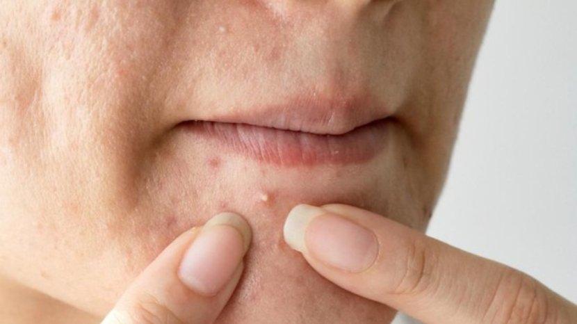 4 Kandungan Skincare Ini Sering Disangka Penyebab Jerawat