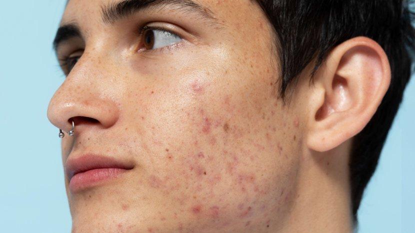 4 Rekomendasi Moisturizer Pria untuk Wajah Berjerawat: Bisa Kamu Dapatkan di Shopee