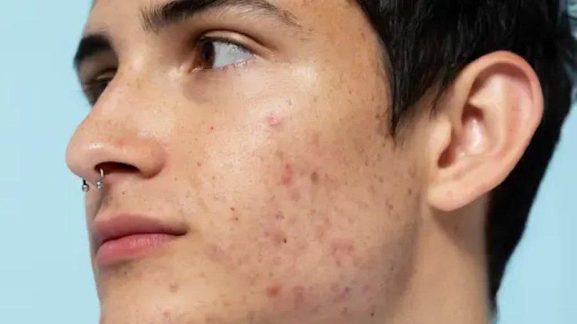 4 Rekomendasi Moisturizer untuk Menghilangkan Bekas Jerawat Hitam