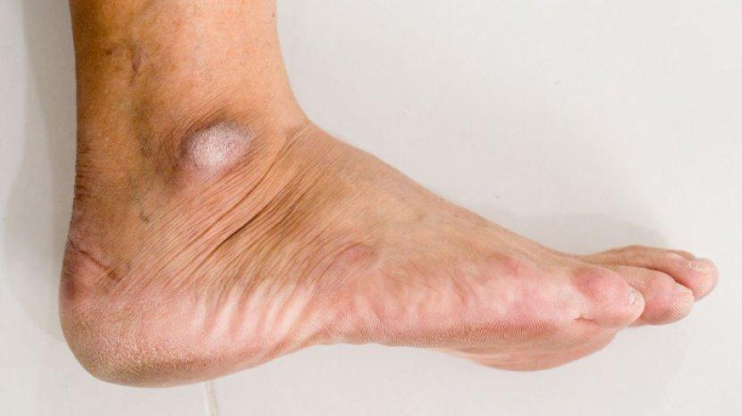 4 Tips Memutihkan Mata Kaki yang Hitam dan Terasa Kering, Lebih Cerah dan Lembap