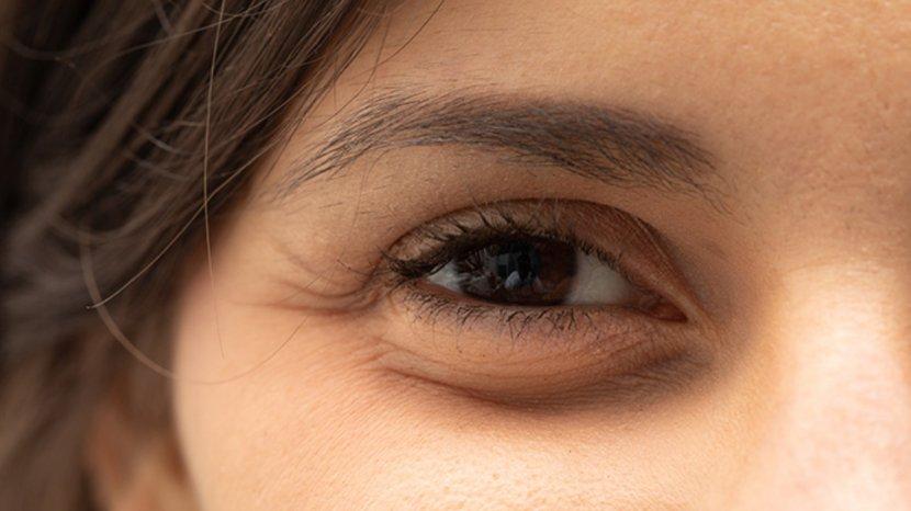 5 Cara Mengatasi Kantung Mata Paling Ampuh: Dimulai dari Skincare