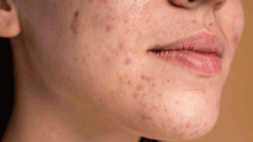 5 Rekomendasi Obat Jerawat Under 100 Ribu Sudah BPOM