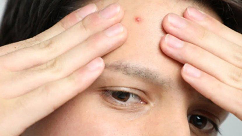 5 Rekomendasi Serum Penghilang Bekas Jerawat yang Manjur dan Mencerahkan