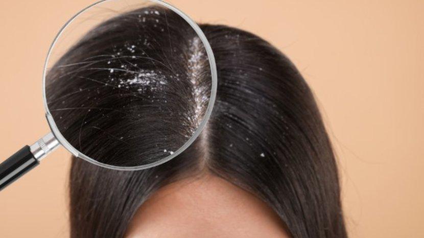 5 Rekomendasi Shampoo Pencegah Ketombe Mulai 50 Ribuan