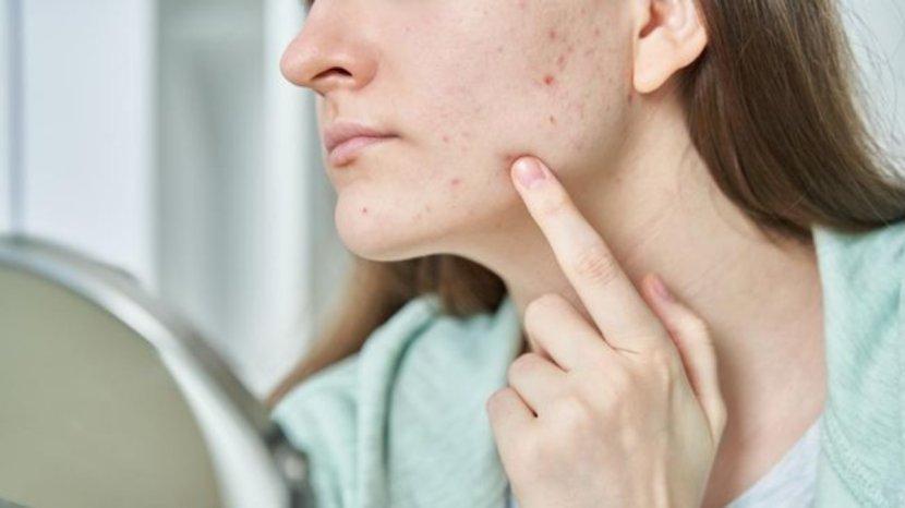 5-Tips-Meredakan-Jerawat-Bengkak-dan-Terasa-Nyeri-Salah-Satunya-Kompres-Menggunakan-Es-Batu.jpg