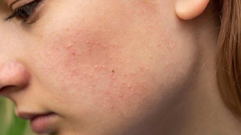 5-Tips-dan-Trik-untuk-Menyembuhkan-Beruntusan-Kecil-pada-Wajah-Menggunakan-Bahan-Alami.jpg