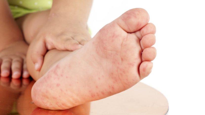 5 Bahan Alami ini Ampuh untuk Mengatasi Kutu Air, Sangat Mudah Dijumpai di Rumah