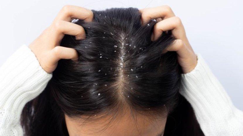 5 Bahan Alami yang Ampuh Mengatasi Rambut Ketombe, Mudah untuk Kamu Temukan