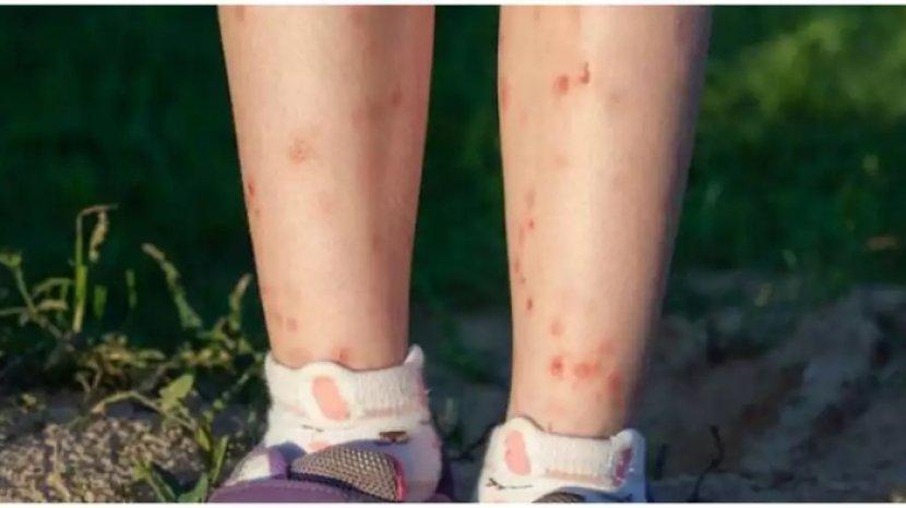 5 Tips Menghilangkan Flek Hitam di Kaki akibat Bekas Gigitan Nyamuk