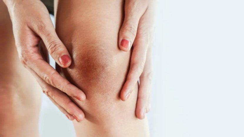 5 Cara Mencerahkan Lutut Hitam Pakai Bahan Alami, Makin PD Pakai Celana Pendek