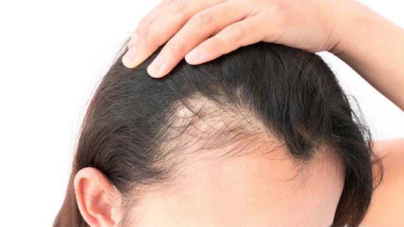 5 Cara Menumbuhkan Baby Hair di Jidat Pakai Bahan Alami