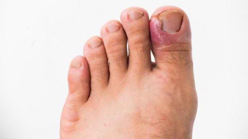 5 Bahan Alami untuk Mengobati Cantengan di Kaki, Salah Satunya Rendam pakai Garam